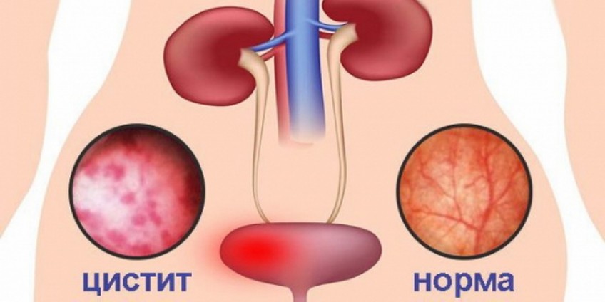Алтернативно лечение на цистит